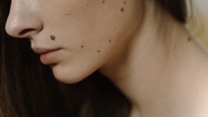 eliminar lunares de la cara